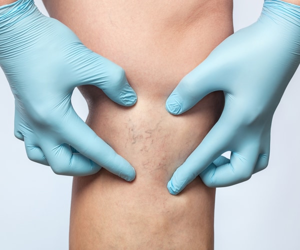 blood vessels on the leg