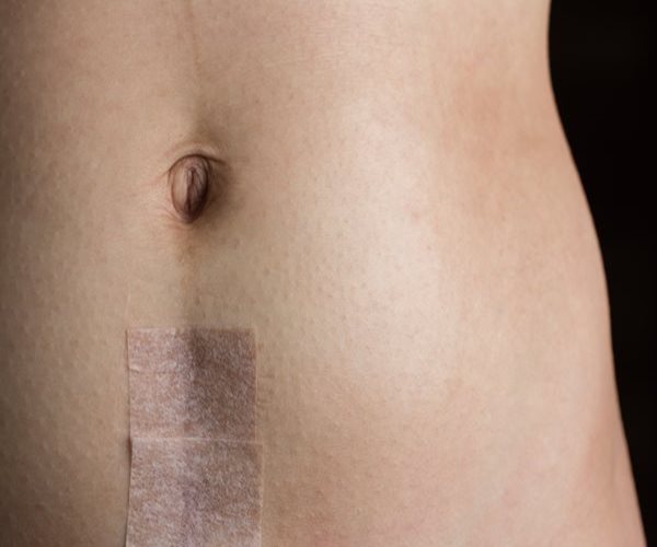 Repeat C-Sections No Long-Term Risk for Baby