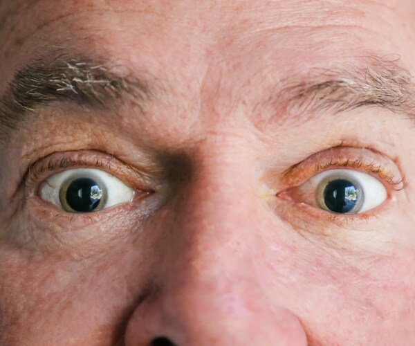 close up of man's eyes -- both are dilated