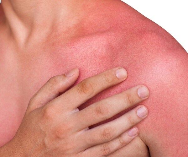 man with sunburn on his chest