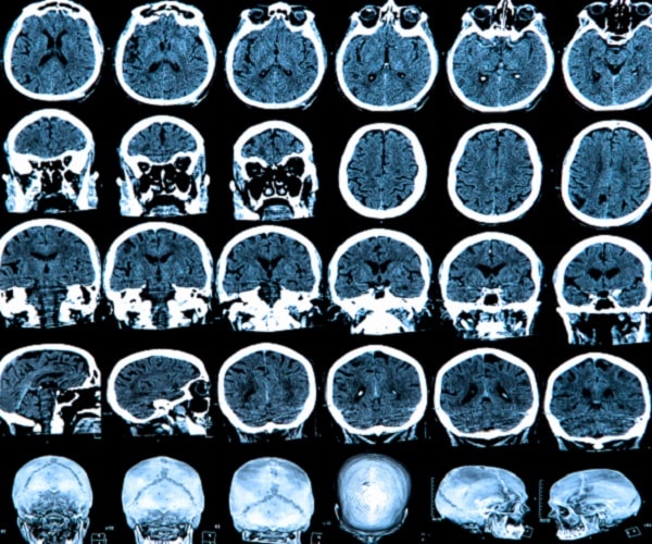 ADHD, Parkinson's New-Found Link Even Stronger With Ritalin