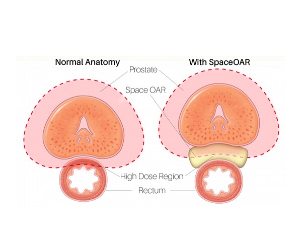 Prostate Cancer Treatment Side Effects Aren't Side Issues When They Happen to You