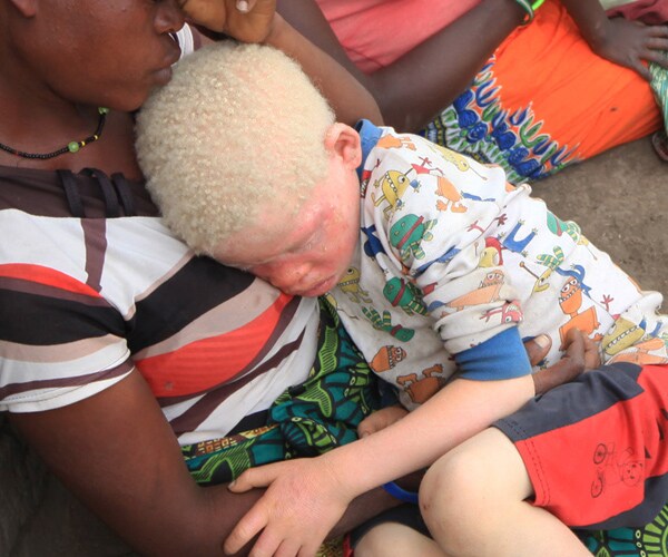 Albino Body Part Sale on the Rise in Malawi, Spurred by Belief They Contain Powers