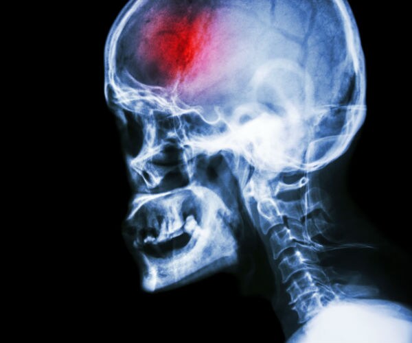 an xray of a brain with a red area indicating damage