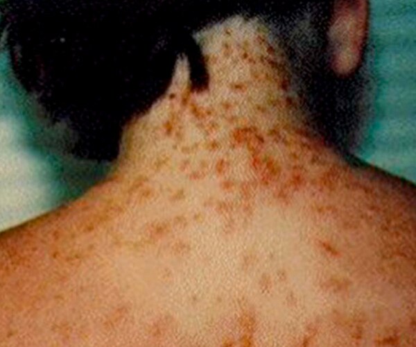 Sea Lice Infestation in Florida Spreads to Swimsuits