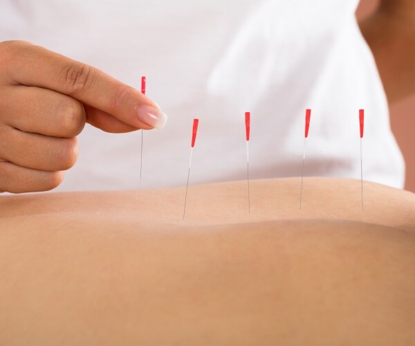 accupunture