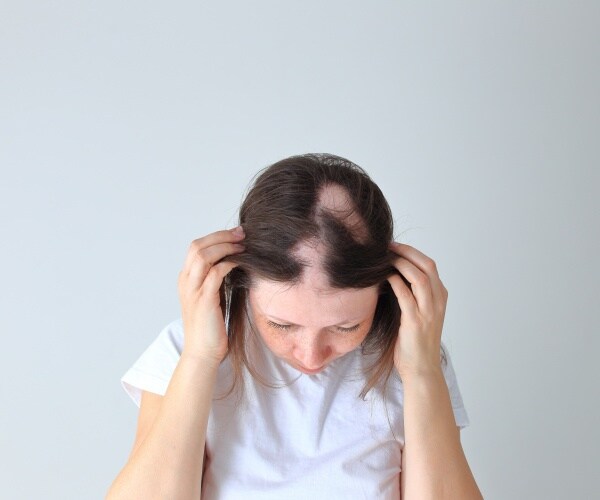 a woman pulling hair to side in mirror to reveal bald spots due to alopecia
