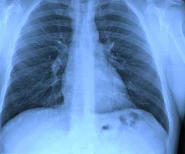 Immunotherapy Beats Standard Chemo for Lung Cancer