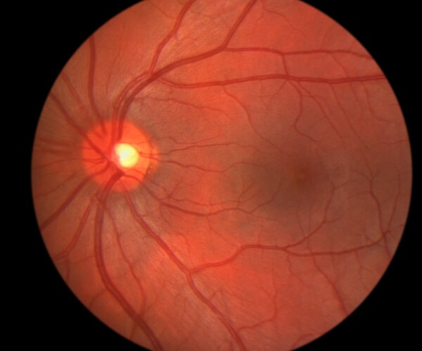 a view inside the eye, showing the optic nerve, retina, and macula