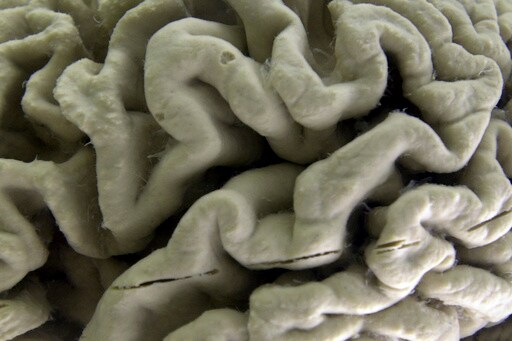 A Subset of Alzheimer's Cases May be Caused by Two Copies of a Single Gene, New Research Shows