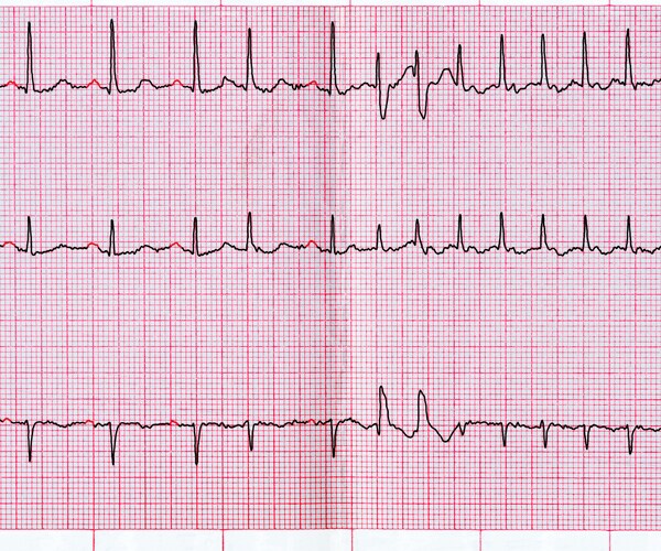 a heart rate chart indicating atrial fibrillation