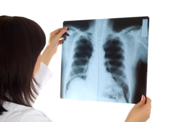 Few False Positives With CT Scans for Lung Cancer