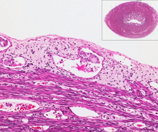 image of endometrial cancer in blood vessels