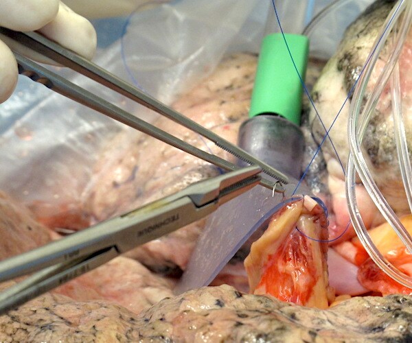 an atrial cuff is sewn into a set of human lungs