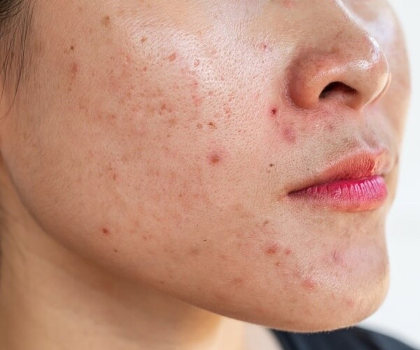 close up of a woman's face with acne