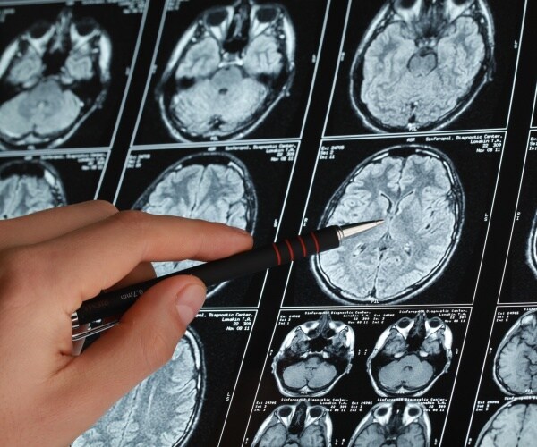 brain scans of people with alzheimers are shown with a person pointing a pen at one