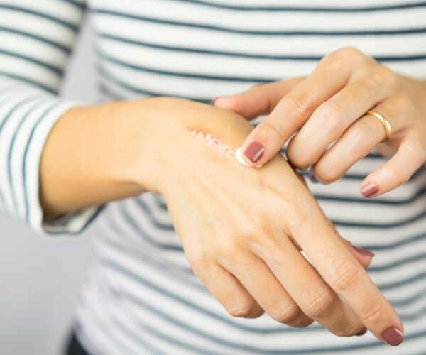 woman applying skin cream to a spot on hand