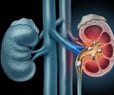 Study: Hydrating May Not Help Prevent Kidney Stones