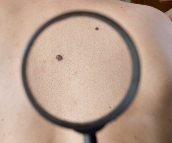 doctor using magnifying glass to look at a melanoma on patient's back