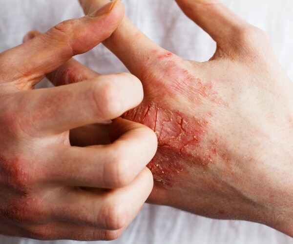 a person's hands with eczema
