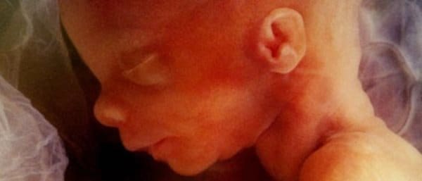 Trump Administration Vastly Expands Global Anti-Abortion Policy