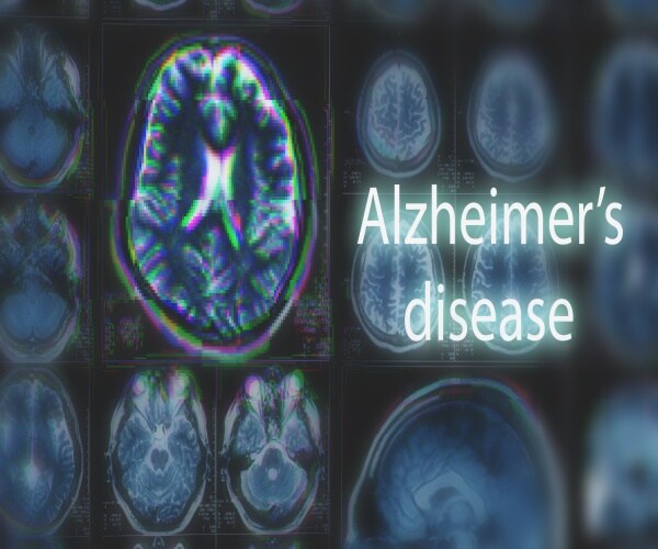 FDA Defends Approval of Controversial Alzheimer's Drug