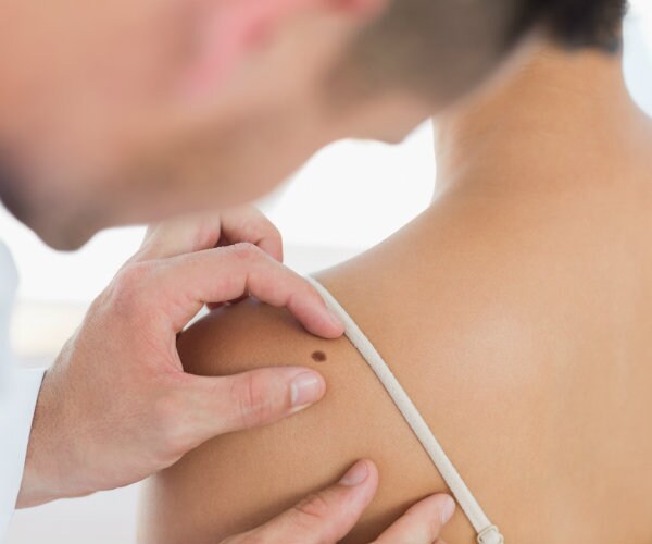 Had Skin Cancer? Here's What You Need to Do