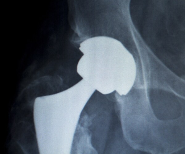 Hip Replacement Can Also Ease Back Pain