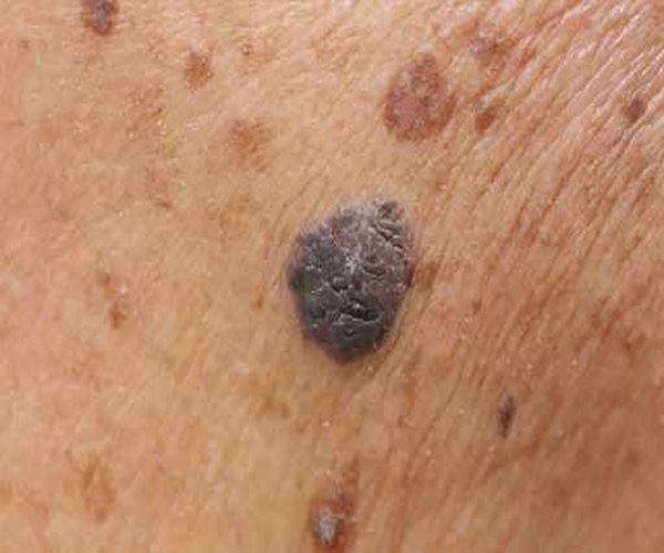 Immune Drug for Deadly Skin Cancer Extends Survival
