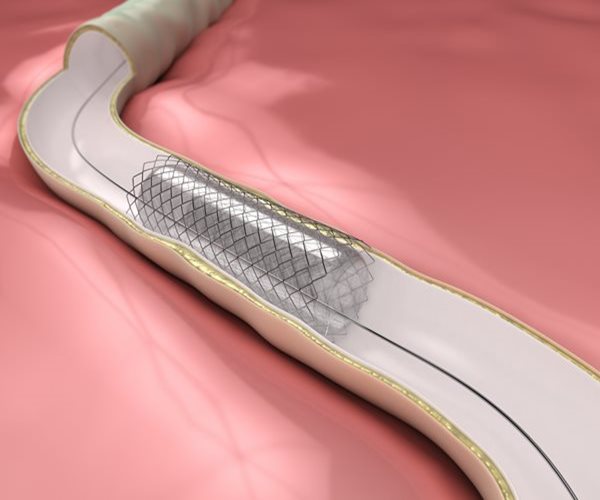 Dissolving Heart Stent Succeeds in Study
