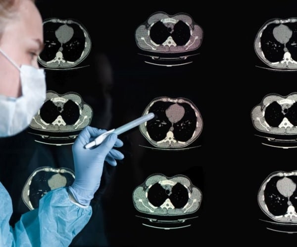 doctor examines CT scan of lungs