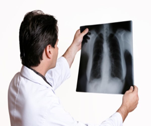 Celtaxsys Cystic Fibrosis Drug Reduces Key Symptom in Mid-stage Study