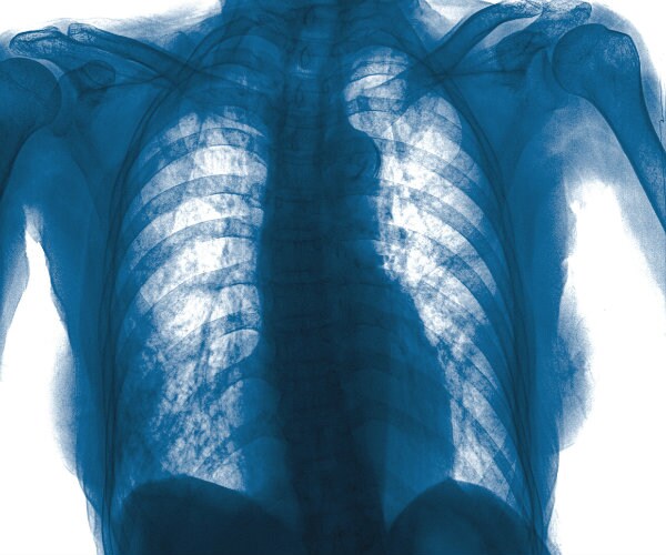 More than 1,000 Tested for TB in Rural Alabama