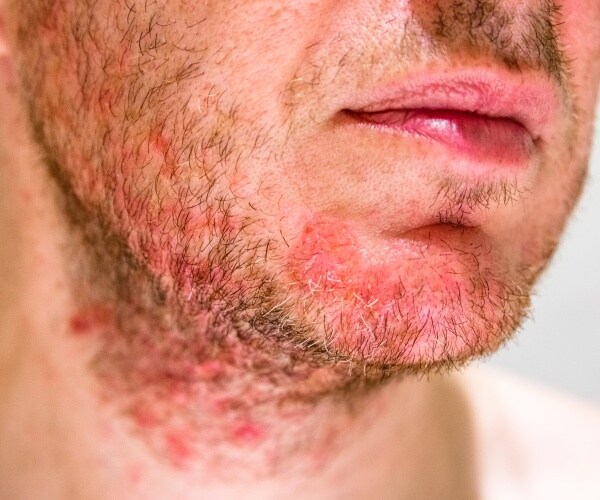 man with seborrheic dermatitis in the beard area