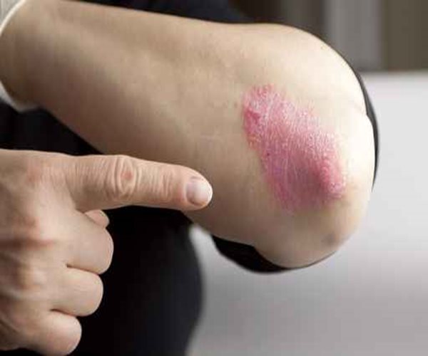 Psoriasis, Depression Go Hand in Hand: Study