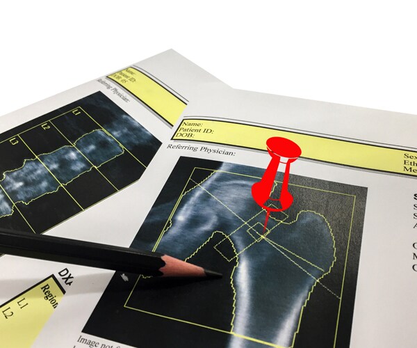 a printout of a bone density scan