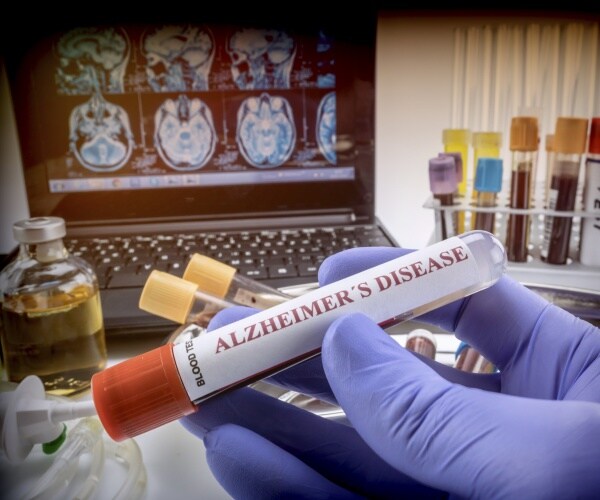 scientist holds vial with blood labeled 'Alzheimer's disease'