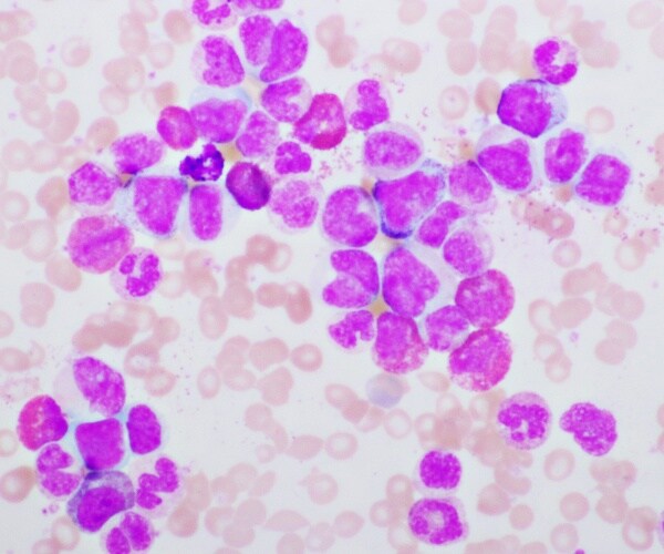 chronic myeloid leukemia cells