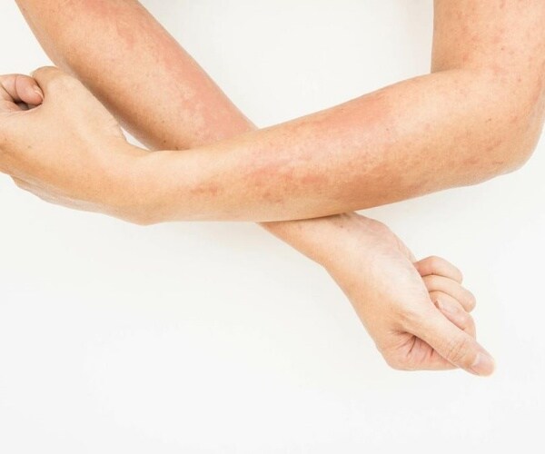 person's arms with eczema