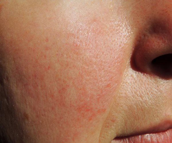 Red Skin? You Could Have Rosacea