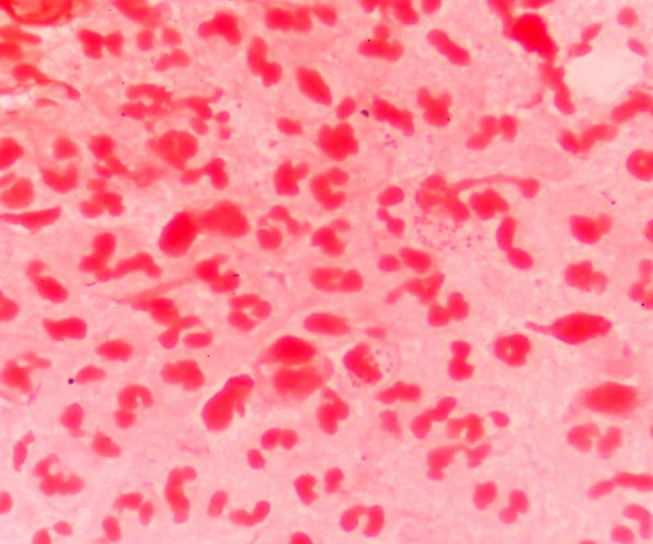 Scarlet Fever on Rampage in Britain