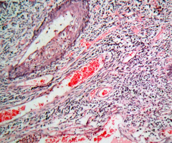 'Liquid Biopsy' Screens Blood for Cancer Before Symptoms Detectable