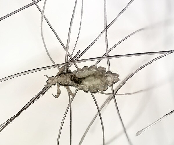 DrugResistant Head Lice Threaten School Kids