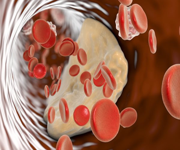Cholesterol Drug Shrinks ArteryClogging Plaque