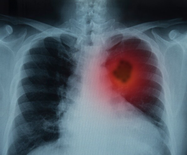 x-ray of lung cancer