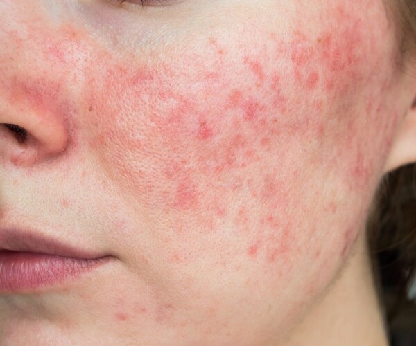 close up of woman's face with rosacea