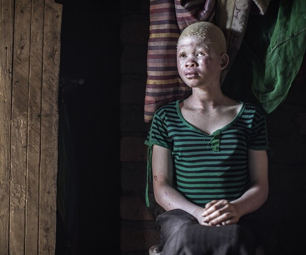 Africa's Albinos Kidnapped and Murdered For Sale of Their Body Parts