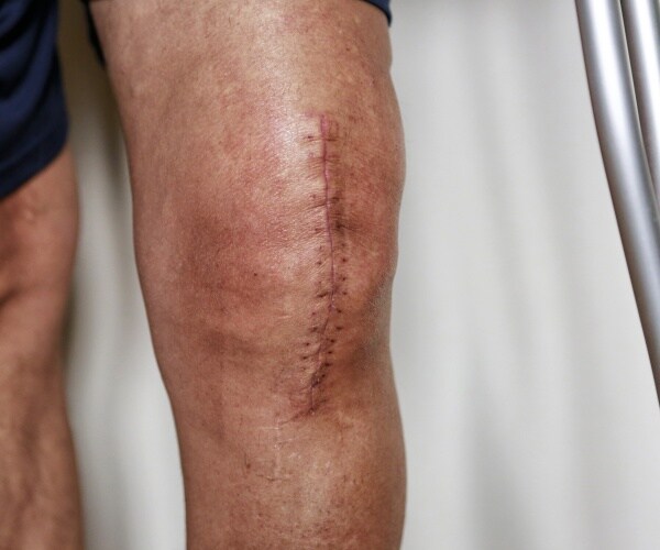 man's knee with knee surgery scar