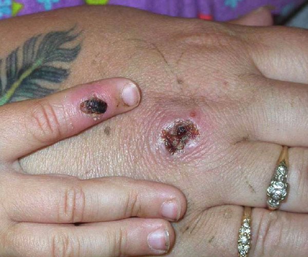 An adult hand and a child's hand, both with sores.