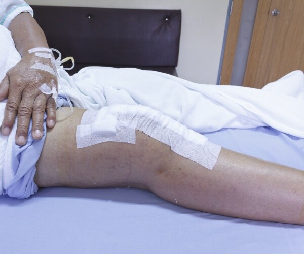a person's leg after knee replacement, with bandages, in hospital